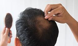 Hair Loss Treatment