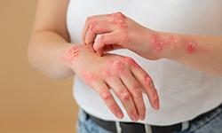 Itchy scaly patches (Psoriasis Treatment)