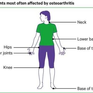 osteoarthritis1