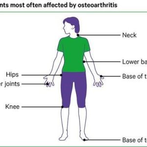 osteoarthritis1.jpg